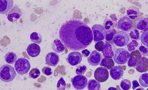 Leucemia Mieloide Cronica