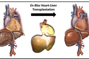 Cuore e fegato trapiantati in blocco, prima volta in Italia (ANSA)