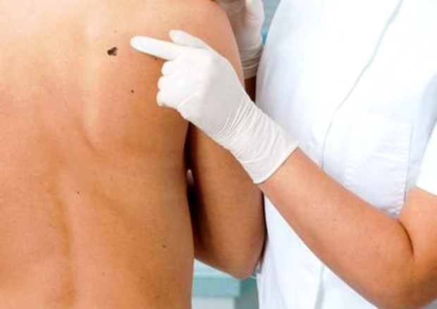 Melanoma, Covid non cambia gestione paziente © ANSA