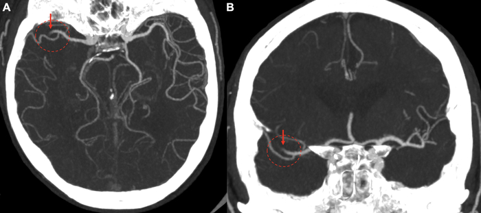 study-suggests-mild-stroke-patients-will-get-worse-medicine