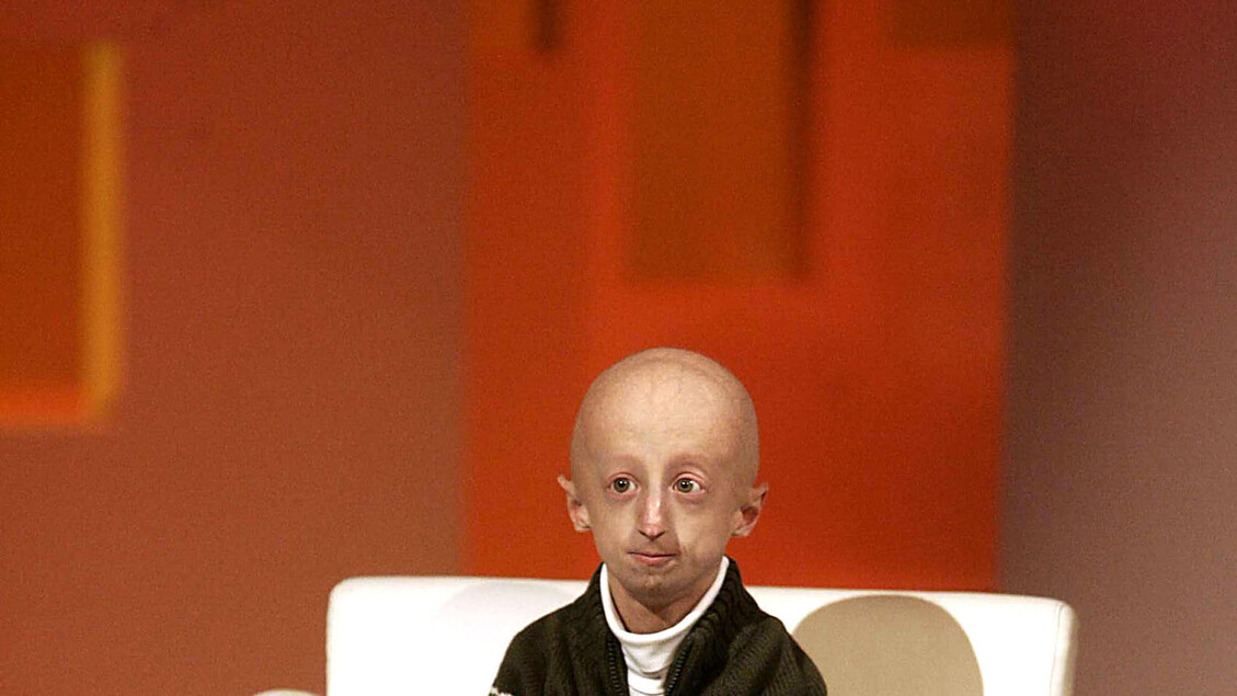 Cos'è la progeria, la malattia che brucia la giovinezza