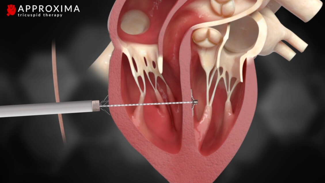 Enea Tech investe in Approxima su tecnologia in cardiochirurgia