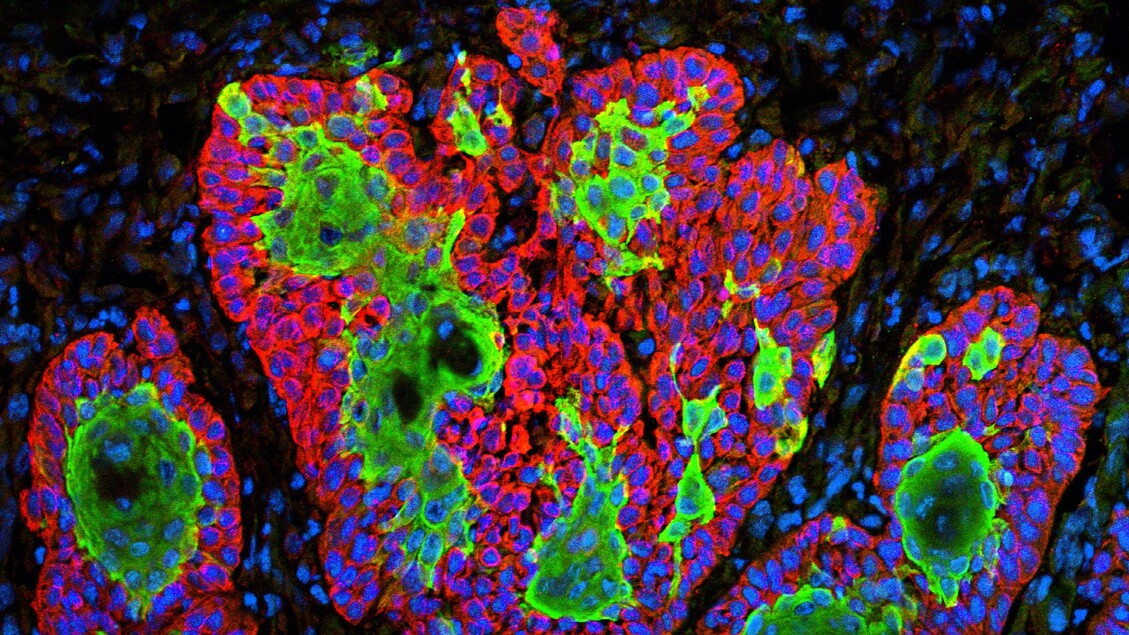 Trovato il punto debole delle cellule tumorali più resistenti