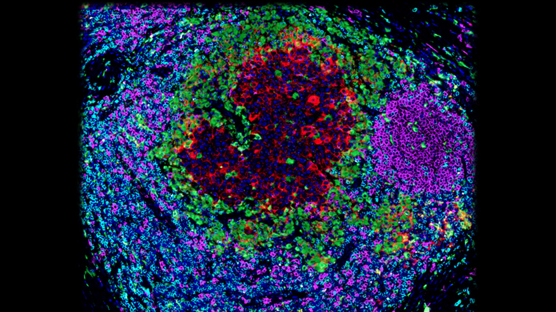 L'aspirina può prevenire le metastasi, vista in azione nei topi