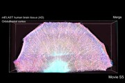 Zoom su un cervello colpito dall'Alzheimer (fonte: Chung Lab/MIT Picower Institute)