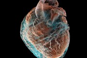 Un cuore sano a confronto con uno malato, in un dettaglio mai visto (fonte: Brunet et al., Radiology)