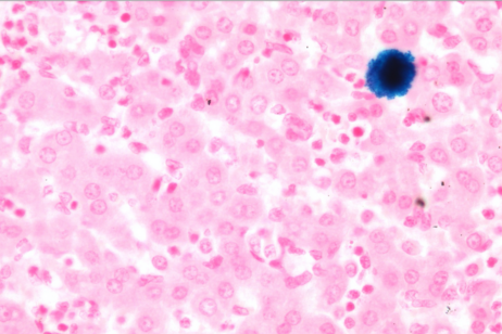 Il tessuto del fegato visto al microscopio, in blu un macrofago pieno di ferro (fonte: Claudio Tripodo)