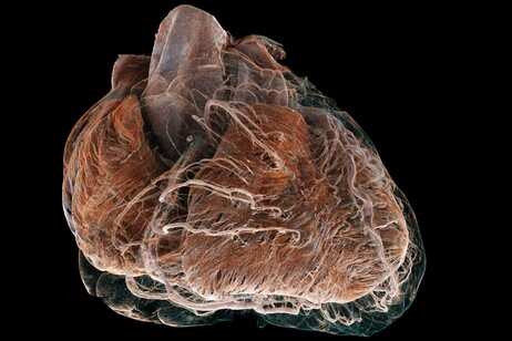 Ricostruzione  3D di un cuore malato (fonte: Brunet et al., Radiology)