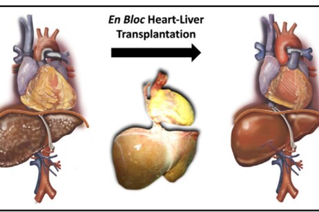 Cuore e fegato trapiantati in blocco, prima volta in Italia