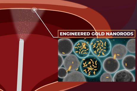 Rappresentazione grafica di un intervento basato sull'utilizzo di nanoparticelle d'oro (fonte: IRCCS Ospedale San Raffaele, Youtube)