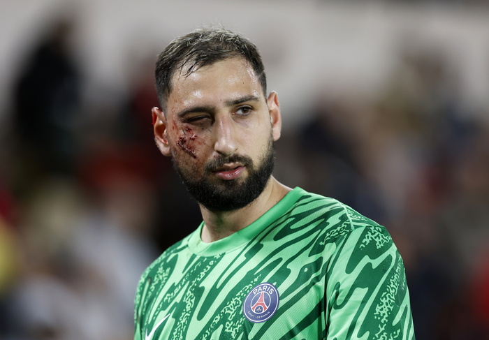 Italy's Donnarumma suffers horror face injury in PSG win