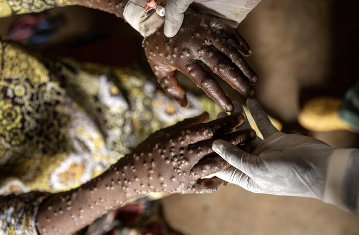 Mpox in Africa, 13 mila casi e 57 morti da inizio anno