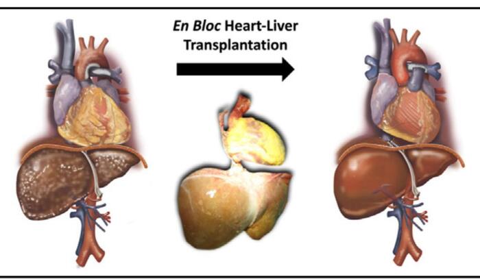 Cuore e fegato trapiantati in blocco come un unico organo, la prima volta in Italia – Medicina – Ansa.it