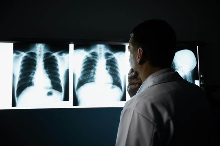 Urine Test Could Detect Lung Cancer Early