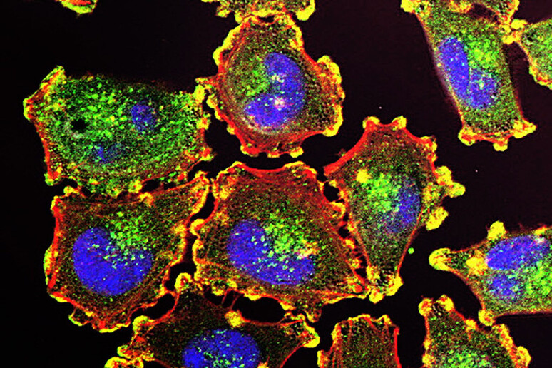 Cellule metastatiche di melanoma (fonte: Julio C. Valencia, NCI Center for Cancer Research) -     RIPRODUZIONE RISERVATA