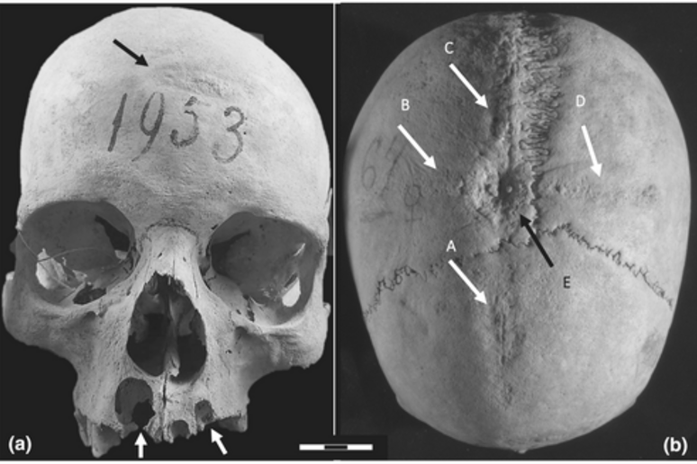 n who lived in the Middle Ages shows the signs of the first ever discovered case of cranial surgery in Longobard Italy (credit: Sapienza University of Rome) - RIPRODUZIONE RISERVATA